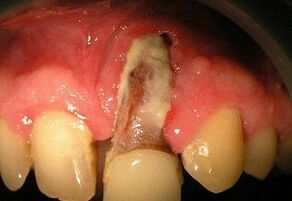osteomüeliit pärast hammaste kaevandamist